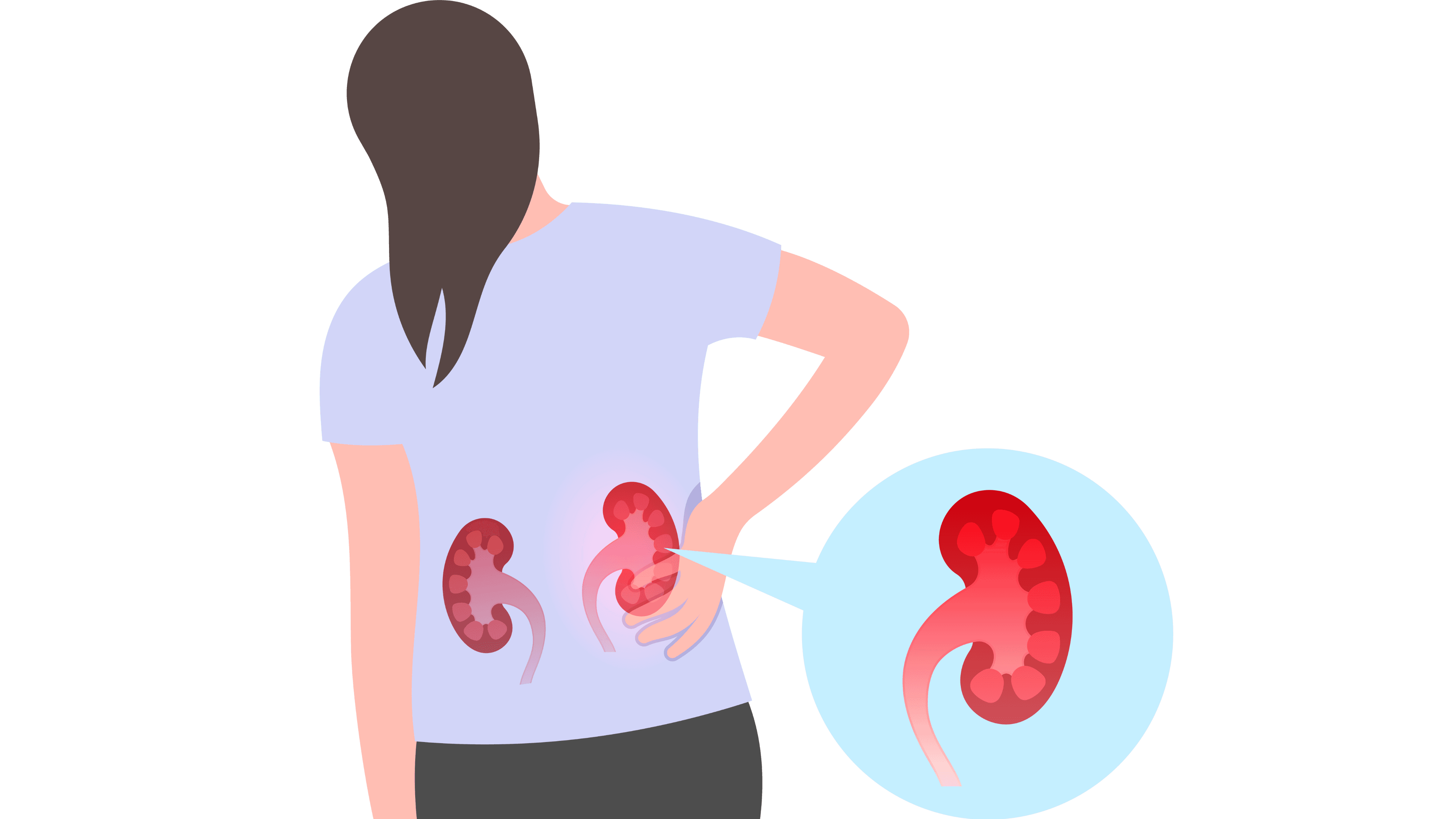 Daycare surgery for kidney stones in Nashik