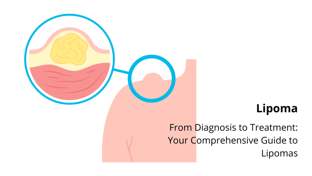 Expert medical team for Lipoma treatment in Nashik