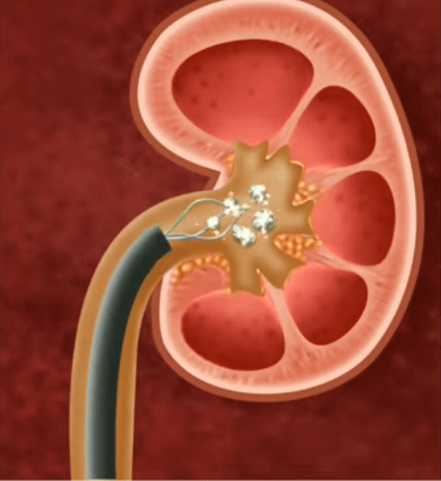 Laser Treatment For Kidney Stone